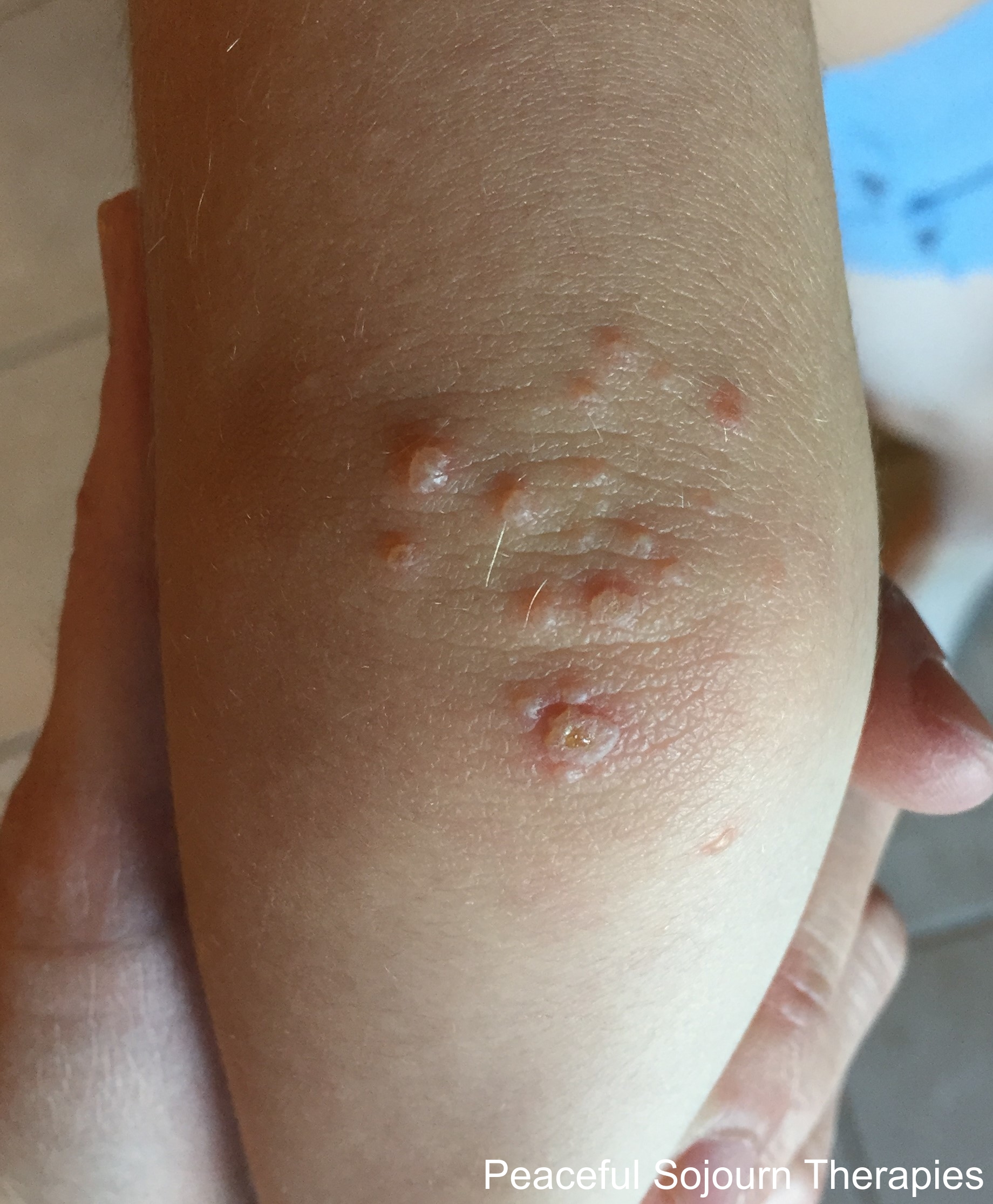 Hand, Foot, and Mouth Disease with Homeopathy INSPIRITED WELLNESS